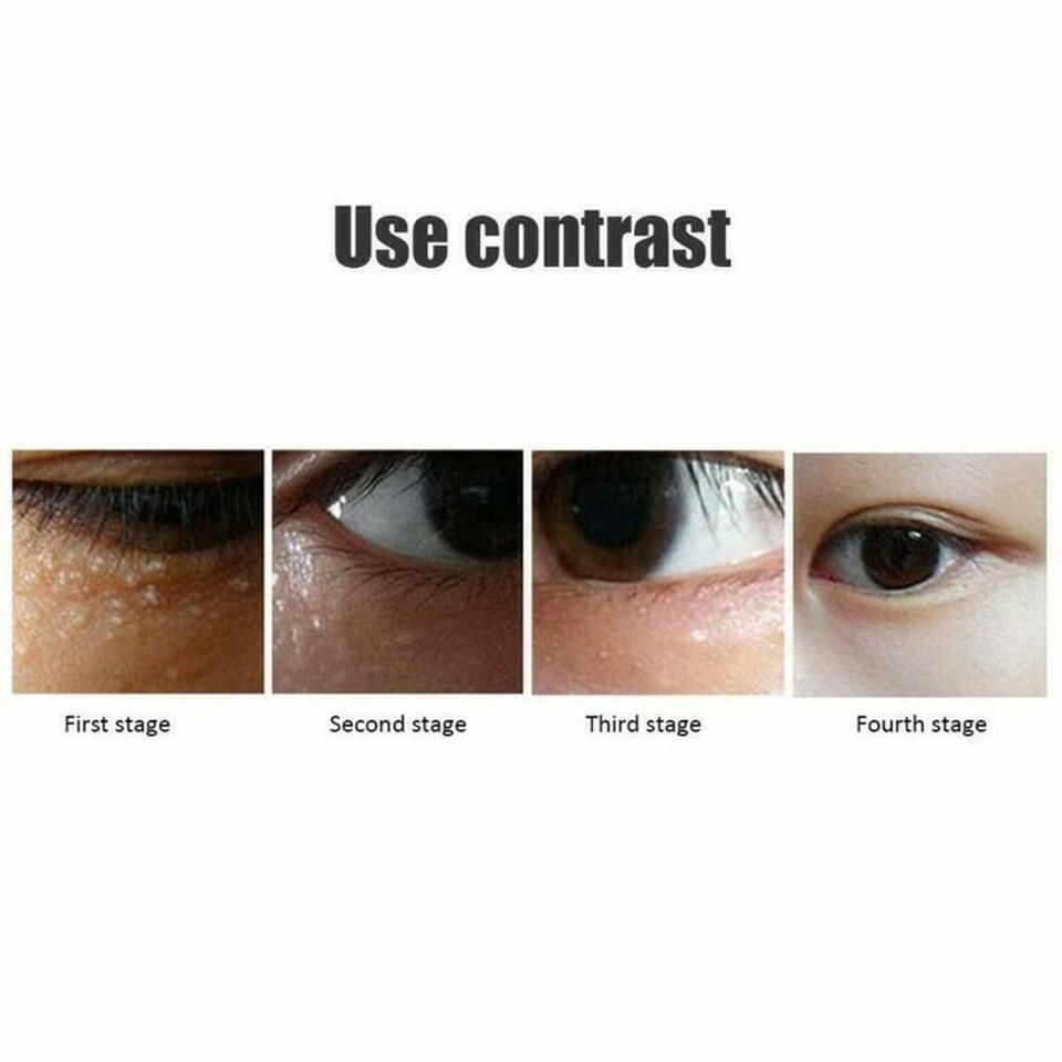 Remove Dark Circles 