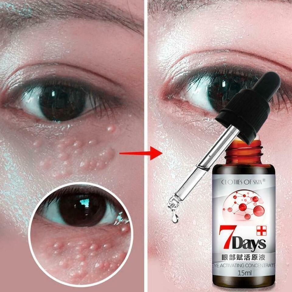 Remove Dark Circles 